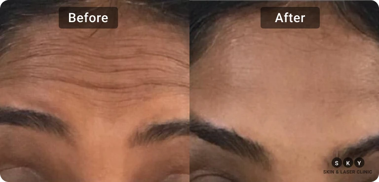 Botox Treatment Before and After