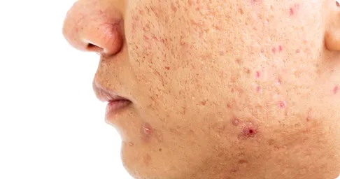 acne_scar_removal,